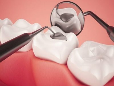 Top 7+ địa chỉ trám răng uy tín Tp.HCM