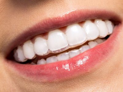 TOP 7 NHA KHOA NIỀNG RĂNG TRONG SUỐT TRẢ GÓP ĐẸP TẠI THỦ ĐỨC TPHCM