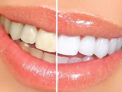 TOP 7 NHA KHOA TẨY TRẮNG RĂNG AN TOÀN UY TÍN GIÁ RẺ TẠI THỦ ĐỨC TPHCM