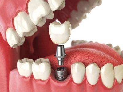 Top 7+ địa chỉ trồng răng Implant uy tín Tp.HCM