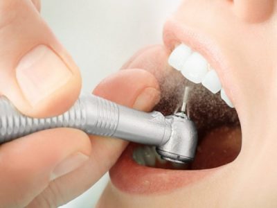 Bảng giá cạo vôi răng giá rẻ năm 2022