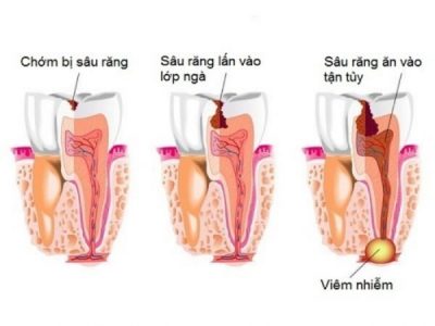 Bảng giá chữa tủy răng giá rẻ năm 2022
