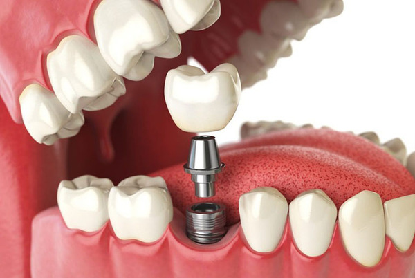 Bạn có thể đến các nha khoa uy tín để trồng răng Implant