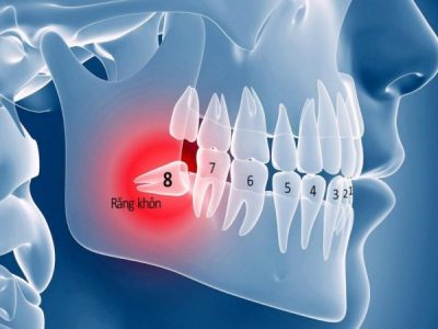 Bảng giá nhổ răng khôn giá rẻ năm 2022