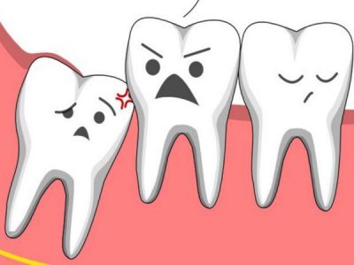 Top 7+ địa chỉ nhổ răng khôn uy tín Tp.HCM
