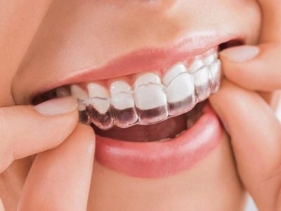 Bảng giá niềng răng trong suốt giá rẻ năm 2022
