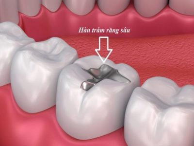 Bảng giá trám răng giá rẻ năm 2022